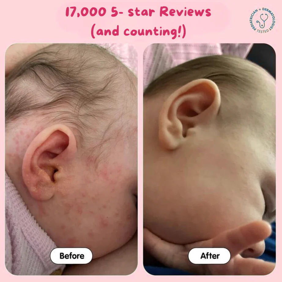 Infant Eczema Relief Tallow™