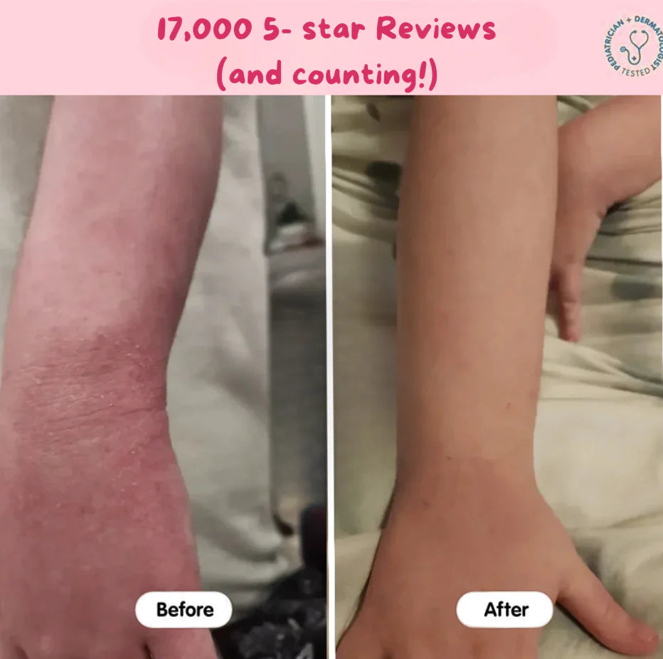 Infant Eczema Relief Tallow™