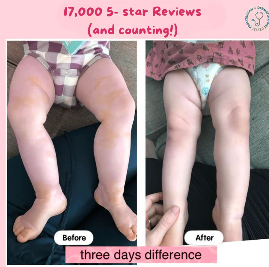 Infant Eczema Relief Tallow™